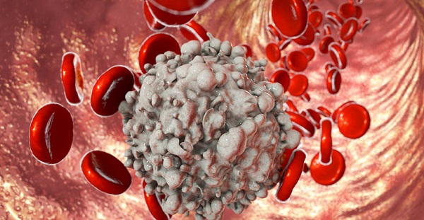 Leucemia-Mieloide-Crónica