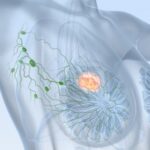 Tumor-metastásico-877x470