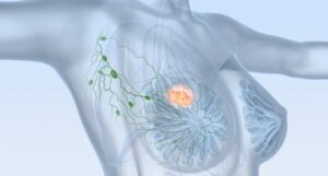 Tumor-metastásico-877x470