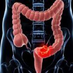 cancer-colon-sintomas-kMaG--620x349@abc