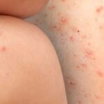 FOTO-VIRUELA-MONO-400x300