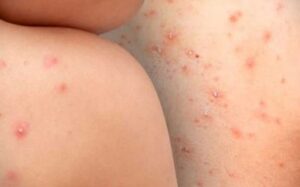 FOTO-VIRUELA-MONO-400x300