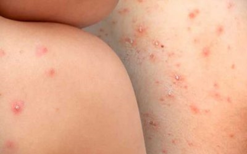 FOTO-VIRUELA-MONO-400x300