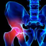 coxartrosisopt-1-768x659