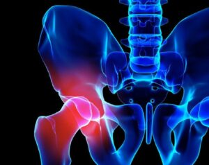 coxartrosisopt-1-768x659