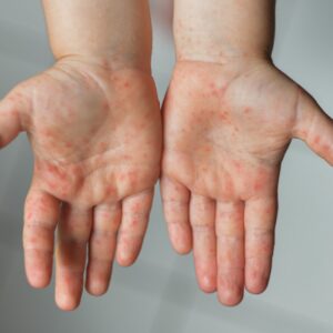 viruela-del-mono-en-ninos-y-embarazadas-importantes-medidas-de-prevencion-md