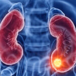 cancer-rinon-e1675157256149