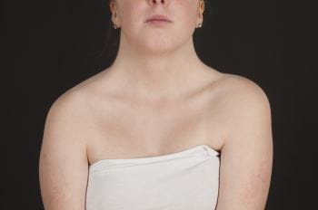 c0328637-turner-syndrome-science-photo-library-high_es