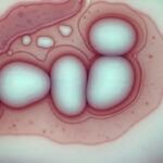 n_dulos_tiroideos_calcificados_imagen_representativa