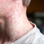 ops-emite-alerta-epidemiologica-por-sarampion-en-las-americas_295c9d34-1f24-49d0-b18d-029accd2c790_medialjnimgndimage=fullsize